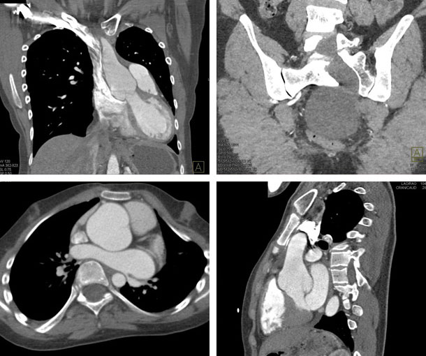 Marfan Syndrome CT Findings