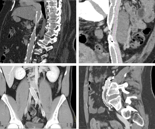 May-Thurner Syndrome CT Findings