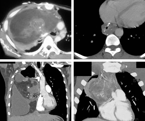 Mediastinal Teratoma CT Findings