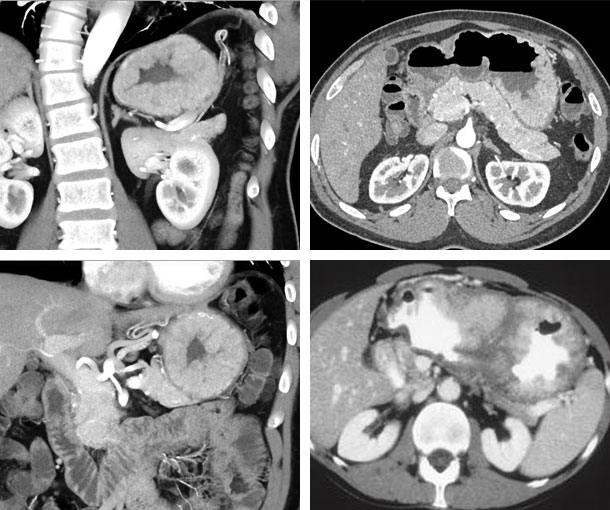 Menetrier Disease CT Findings