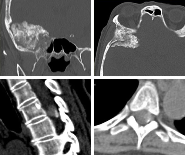 Meningioma CT Findings