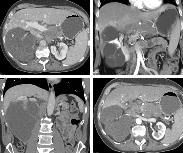 MEST CT Findings