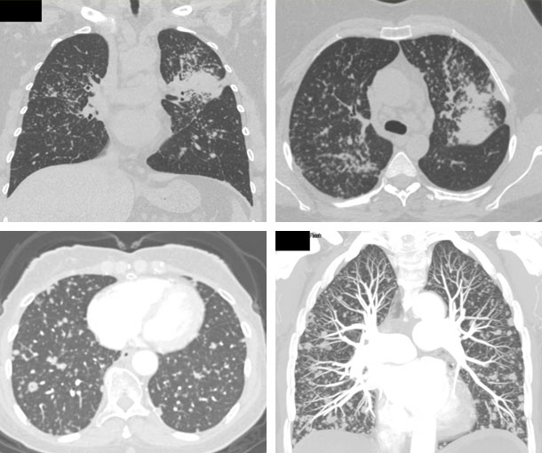 Miliary Tuberculosis (TB)