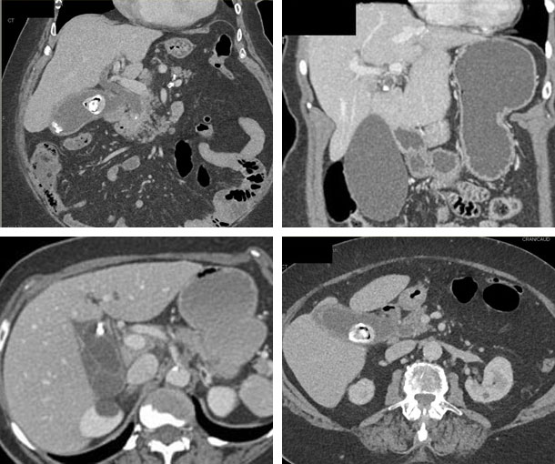 Mirizzi Syndrome CT Findings