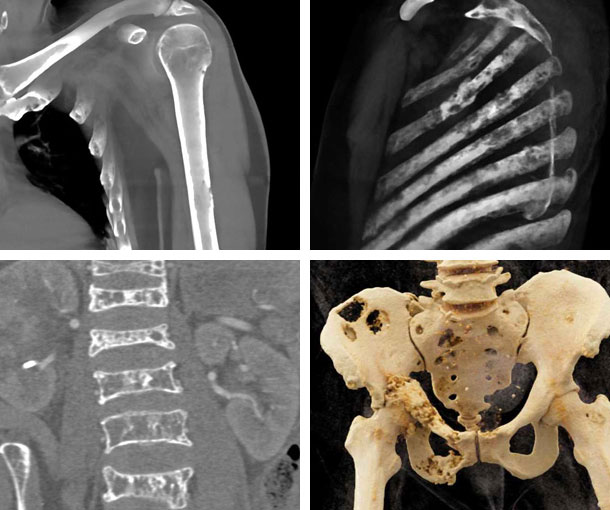 Multiple Myeloma