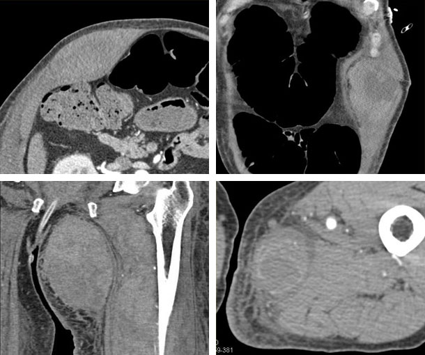 Muscular Hematoma