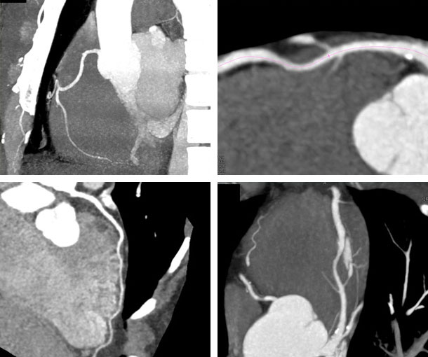 Myocardial Bridging CT Findings