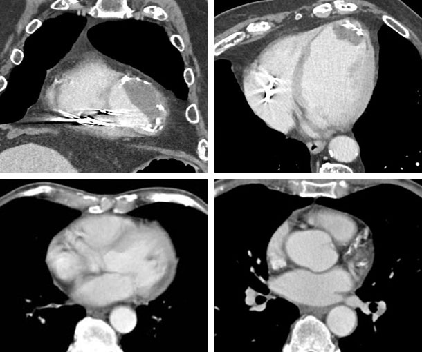 Myocardial Infarction CT Findings