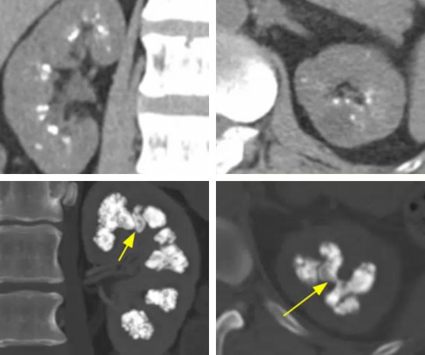Nephrocalcinosis CT Appearance