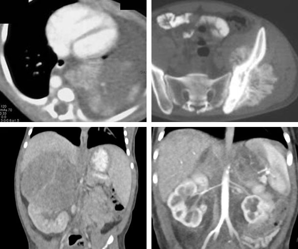 Neuroblastoma CT Findings