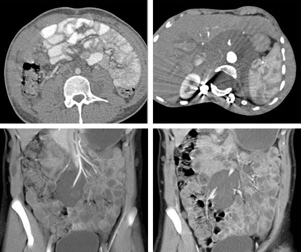 Neurofibromatosis CT Findings