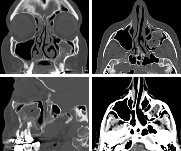 Ossifying Fibroma CT Findings