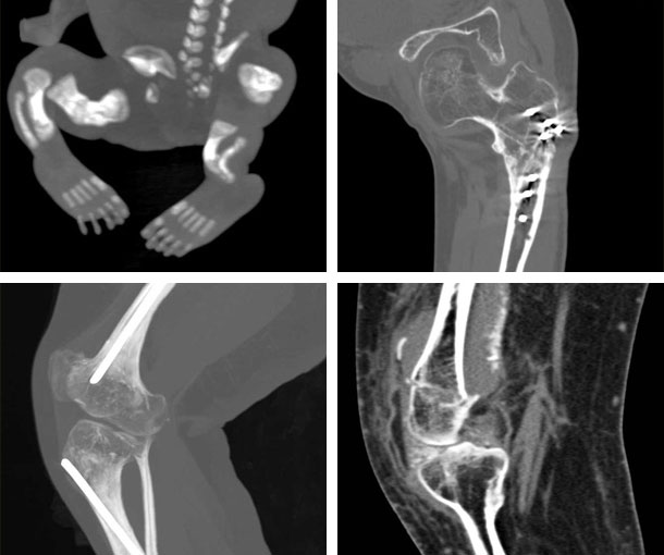 Osteogenesis Imperfecta