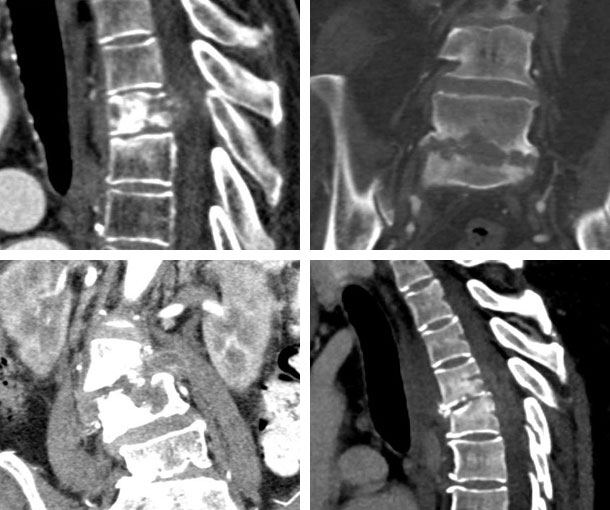 Osteomyelitis