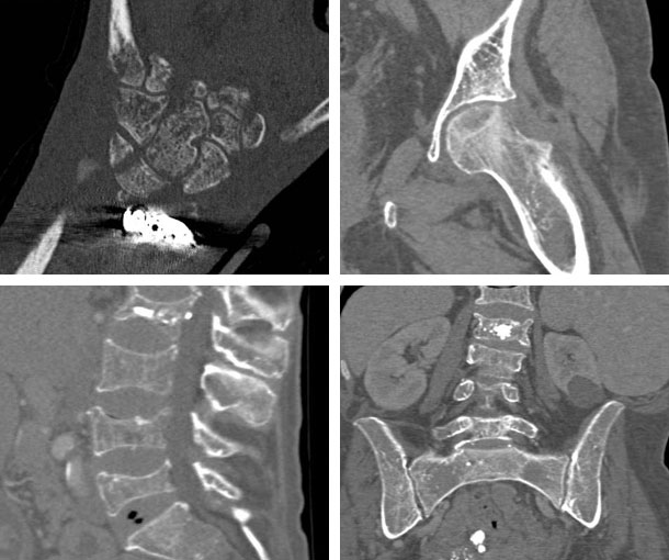 Osteoporosis