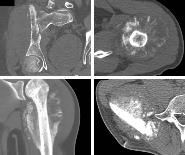 Osteosarcoma