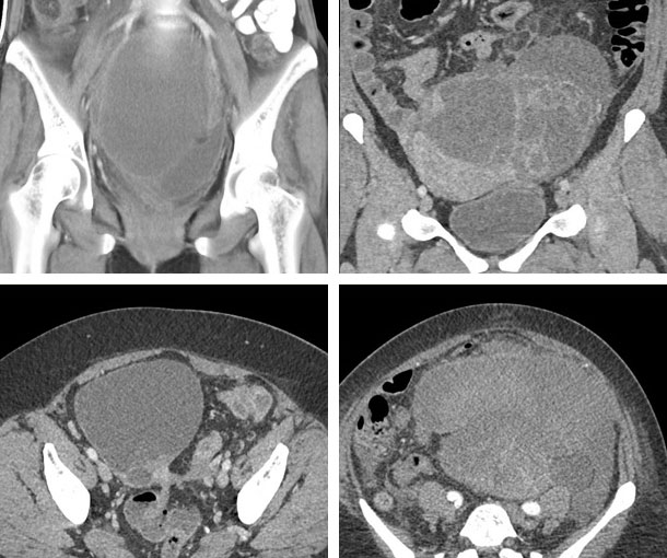 Ovarian Carcinoma CT Findings