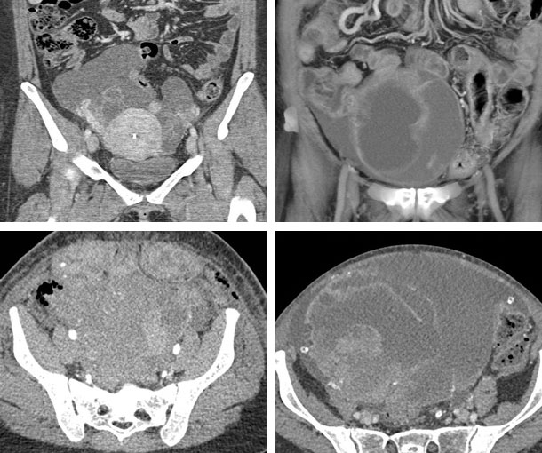 Ovarian Carcinoma CT Findings