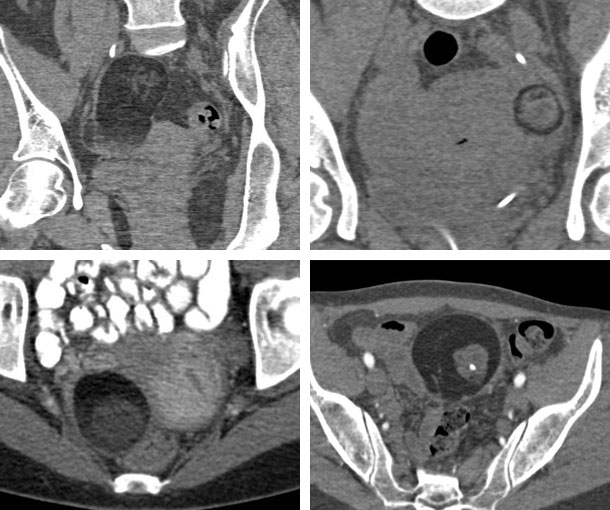 Ovarian Teratoma (Dermoid) CT Findings