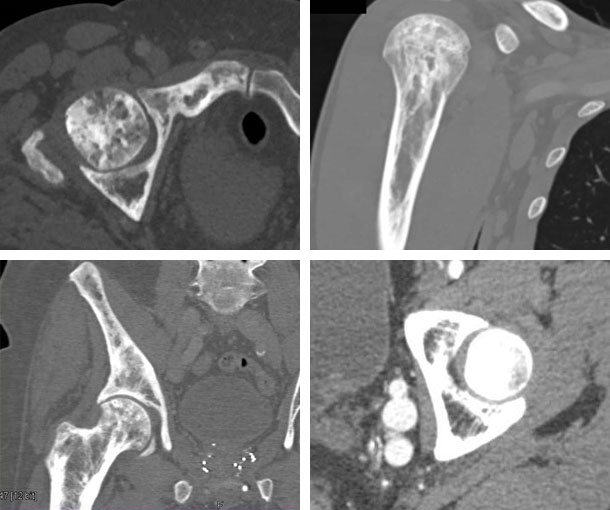 Paget's Disease