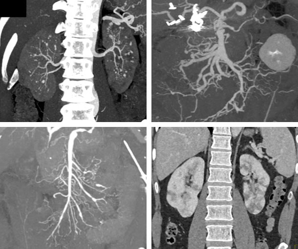 Polyarteritis Nodosa (PAN) CT Findings