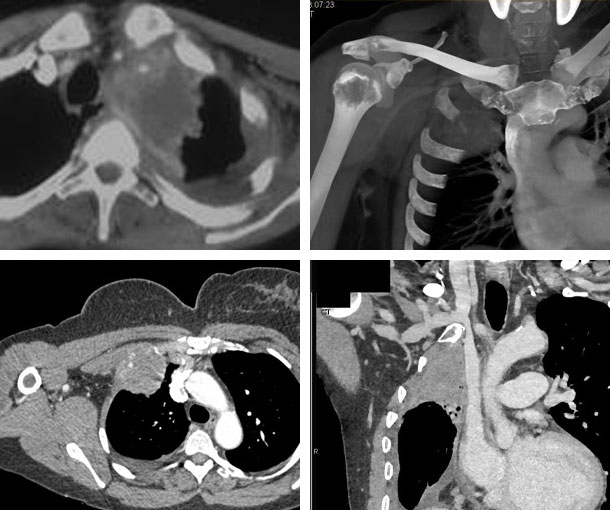 Pancoast Tumor CT Findings