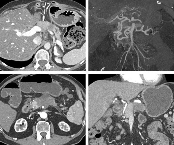 Pancreatic Adenocarcinoma CT Findings