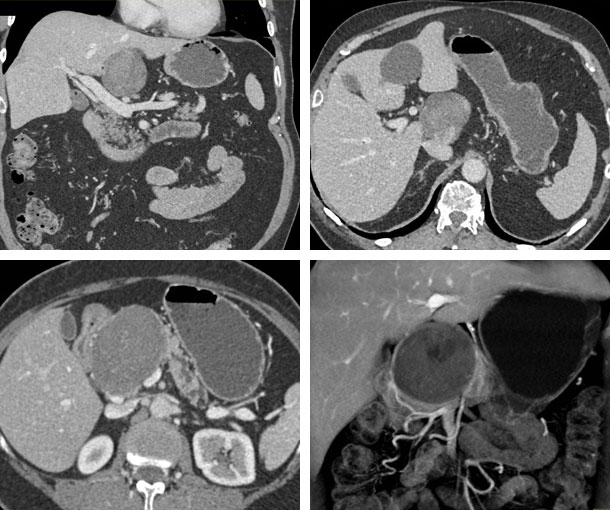 Pancreatic Ganglioneuroma CT Findings