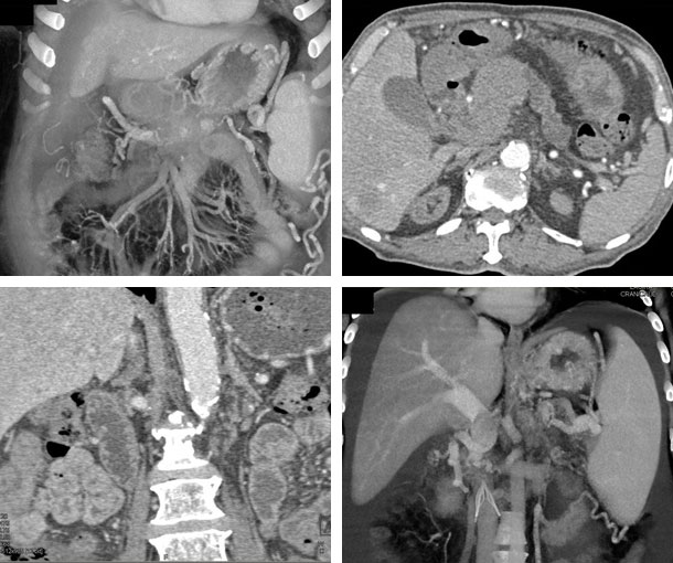 Pancreatic Lymphoma CT Findings