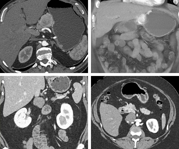 Pancreatic Paraganglioma CT Findings