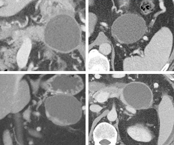 Pancreatic Pseudocyst CT Findings