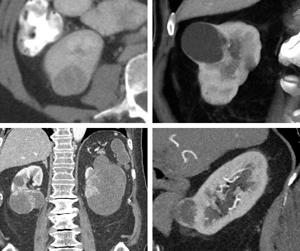 Papillary RCC CT Findings