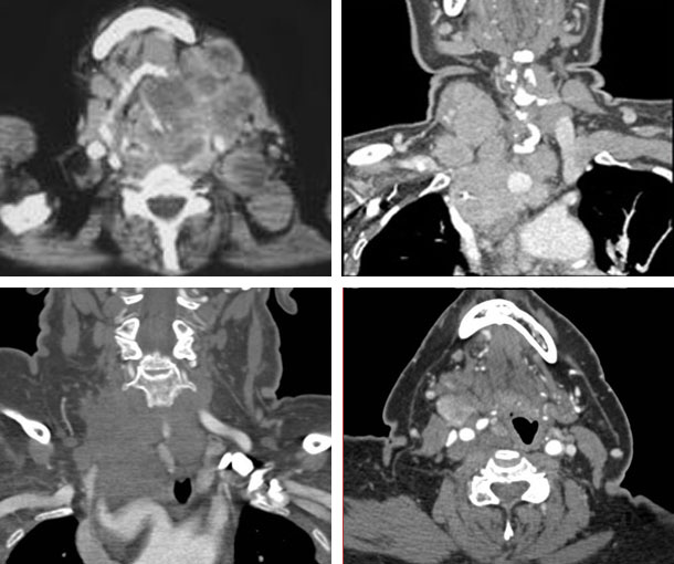 Papillary Thyroid Carcinoma (PTC) CT Findings
