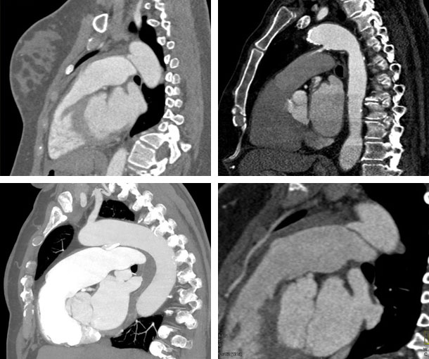 PDA CT Findings