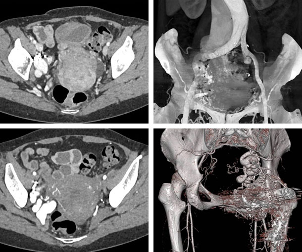 Pelvic AVM CT Findings