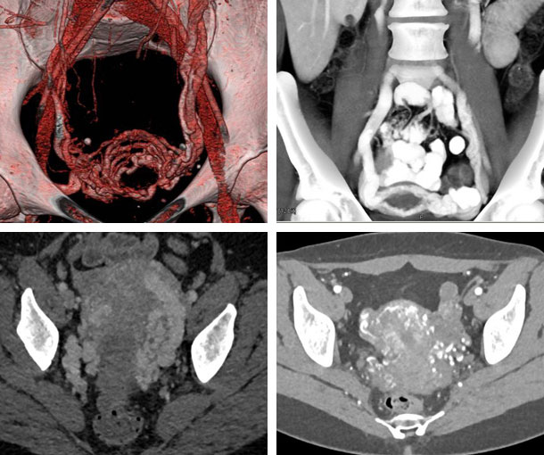 Pelvic Congestion Syndrome CT Findings