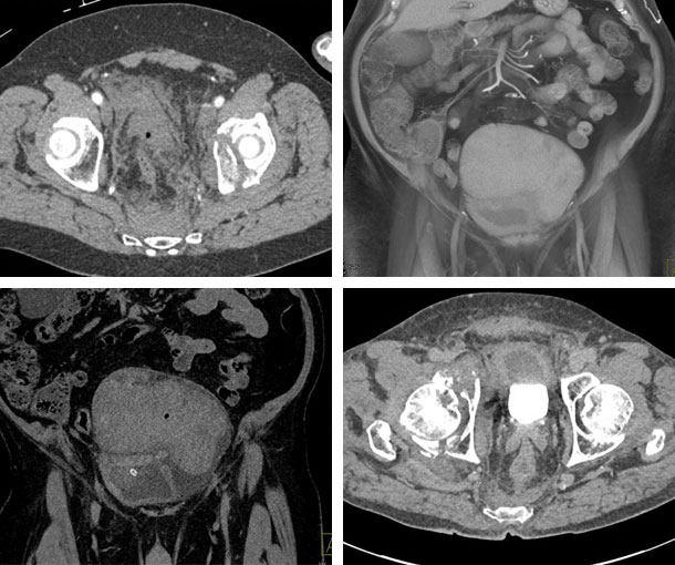 Pelvic Hematoma CT Findings