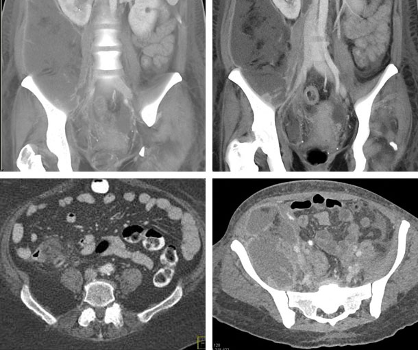 Perforated Appendix CT Appearance
