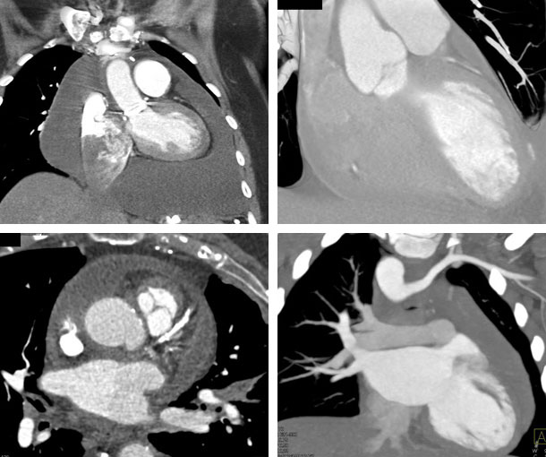 Pericardial Effusion CT Findings