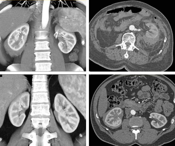 Perirenal Lymphoma CT Appearance