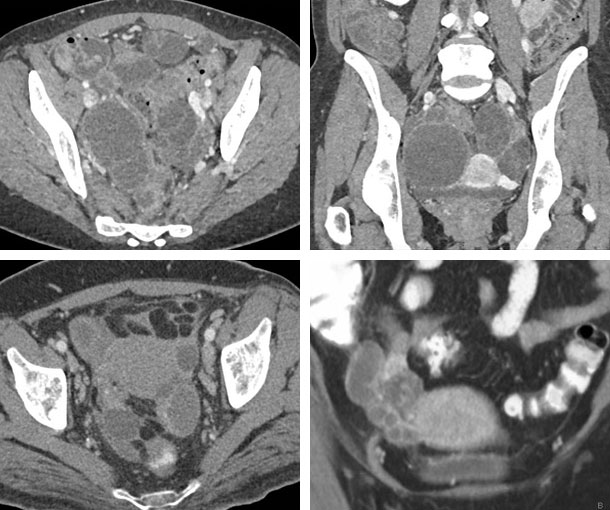 Pelvic Inflammatory Disease CT Findings