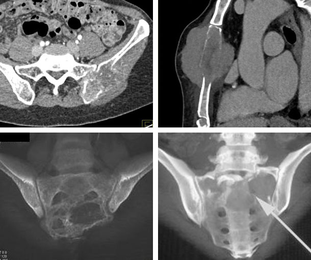 Plasmacytoma CT Findings