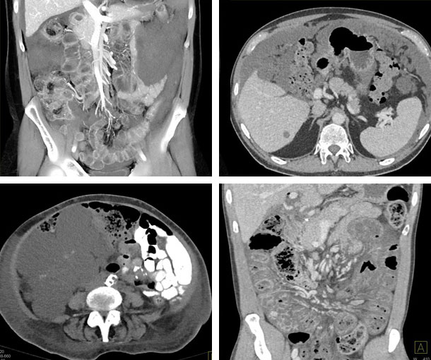 Pseudomyxoma Peritonei (PMP) CT Appearance