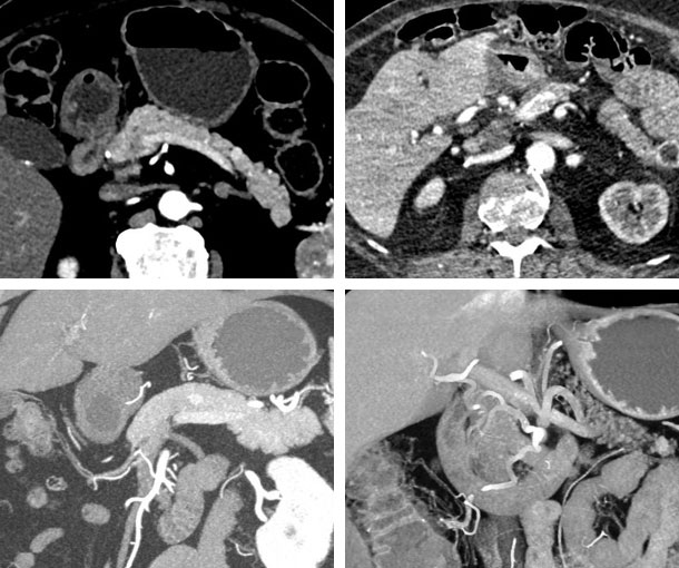 Pancreatic Neuroendocrine Tumor (PNET) CT Findings