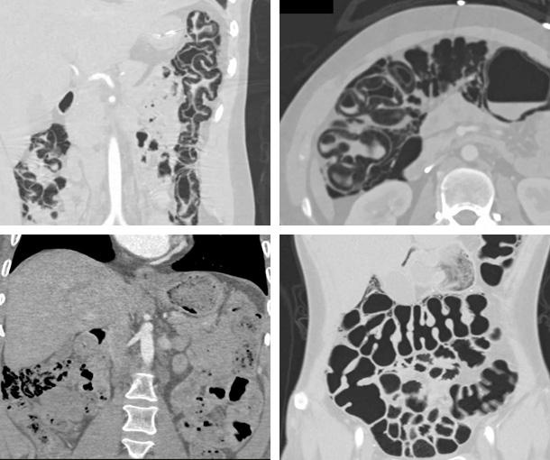 Pneumatosis