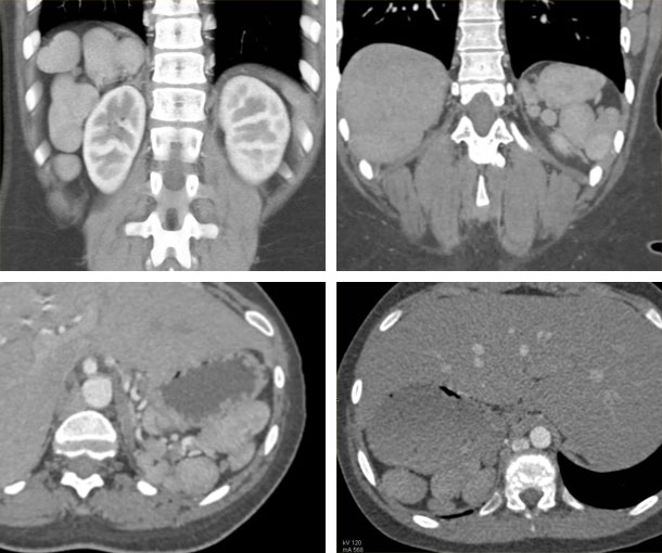Polysplenia CT Appearance