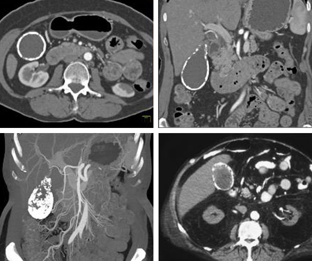 Porcelain Gallbladder CT Findings