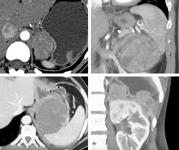 Primary Adrenal Carcinoma