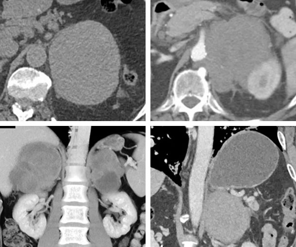 Primary Adrenal Lymphoma