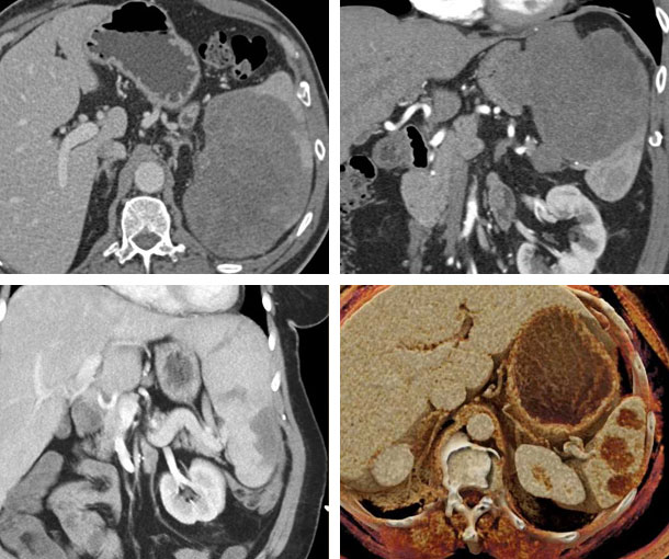 Primary Splenic Lymphoma CT Findings